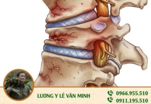 Bệnh giòn xương - Lương y Lê Văn Minh ảnh 2