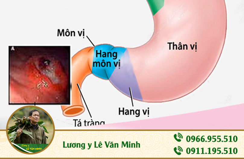 viêm hang vị dạ dày- lương y Lê Văn Minh ảnh 1