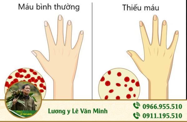 xuất huyết dạ dày ảnh 2 - Lương y Lê Văn Minh